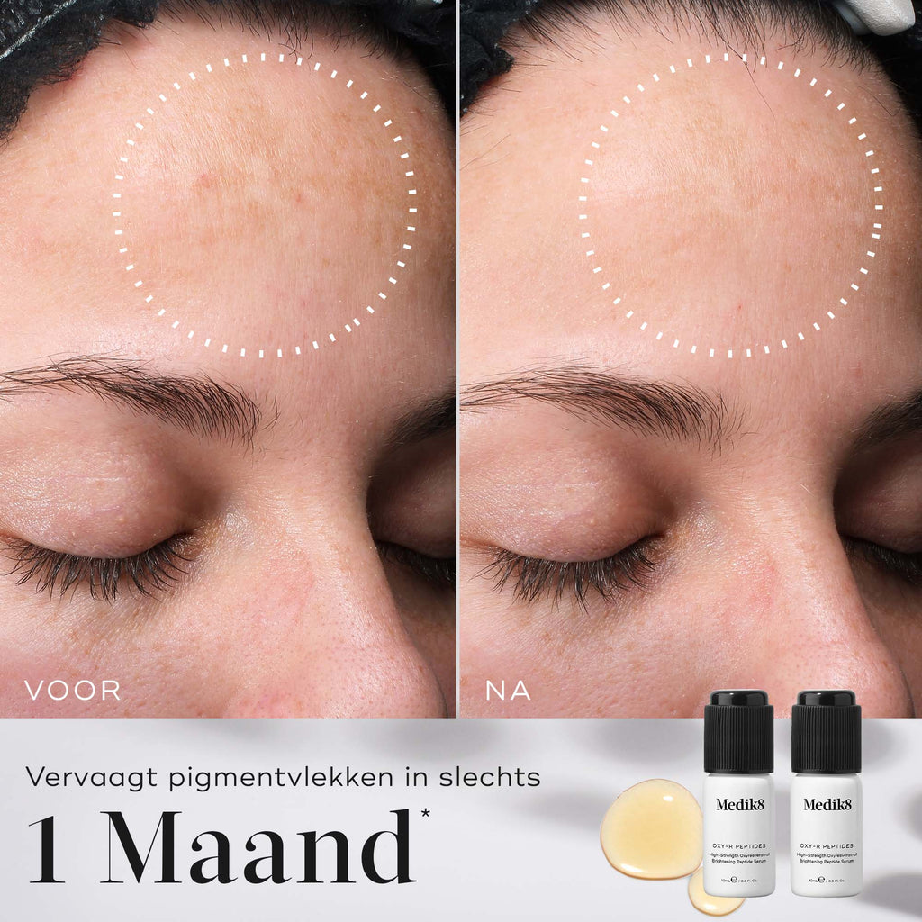 Een voor-en-na vergelijking van het voorhoofd van een persoon waarbij pigmentvlekken zichtbaar zijn vervaagd. Witte stippellijnen omcirkelen de verbeterde zones. Tekst: "Vervaagt de aanblik van donkere vlekken in slechts 1 maand."