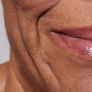 Een extreem bijgesneden close-up van de onderste helft van het gezicht, met focus op de mondhoek en wang. De donker getinte huid toont zichtbare diepe neus-lippenplooien, lachrimpeltjes en verlies van elasticiteit, waardoor zorgen rond stevigheid en verslapping van de huid worden benadrukt.