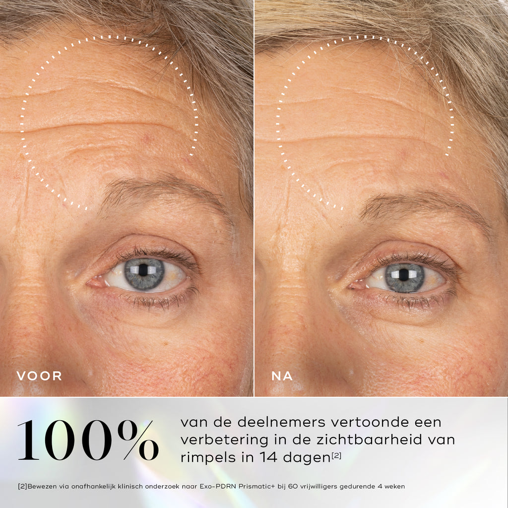Voor- en na vergelijking die een zichtbare verbetering in huidtextuur en gladheid toont na langdurig gebruik van Medik8 Exo-PDRN Prismatic+.